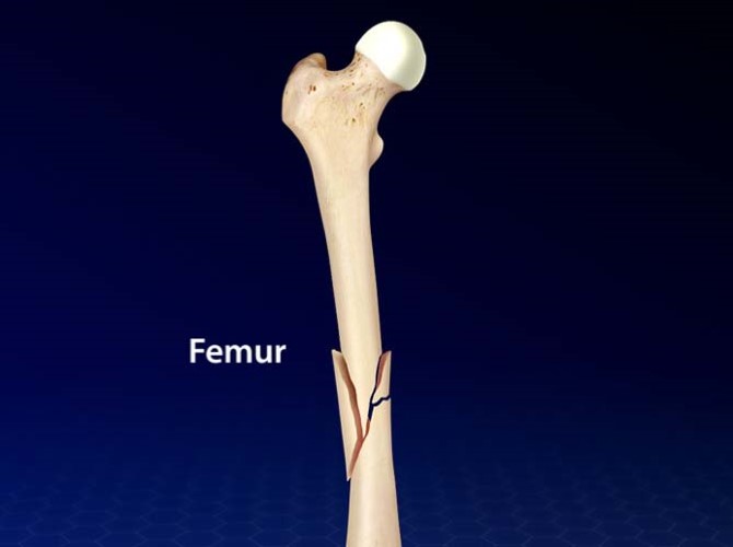 femur-fracture.jpg
